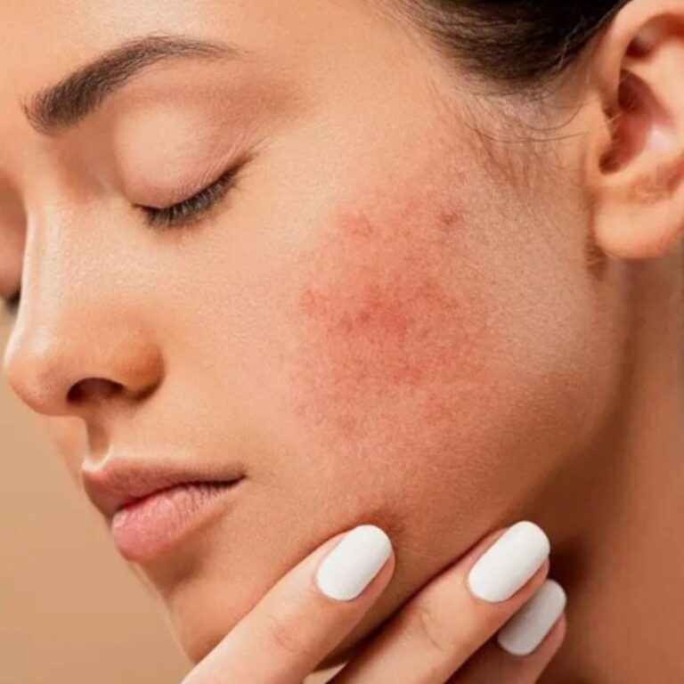 Cinkoderm pasta 25 g